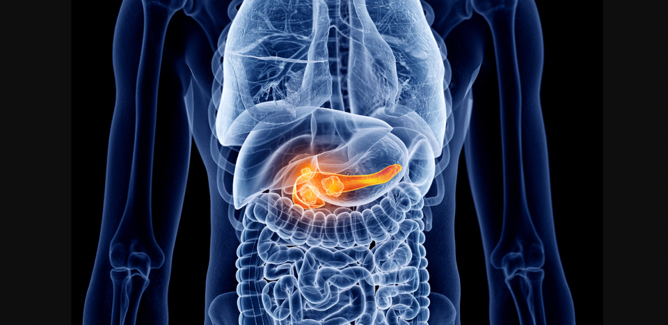 Acute Pancreatitis