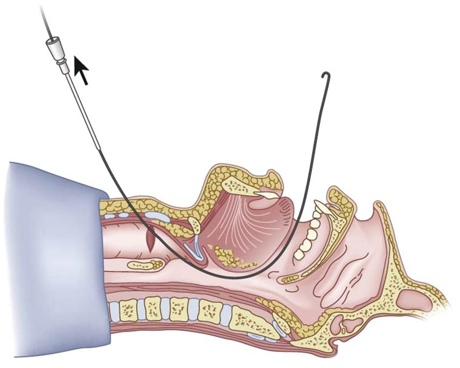 Retrograde tracheal intubation