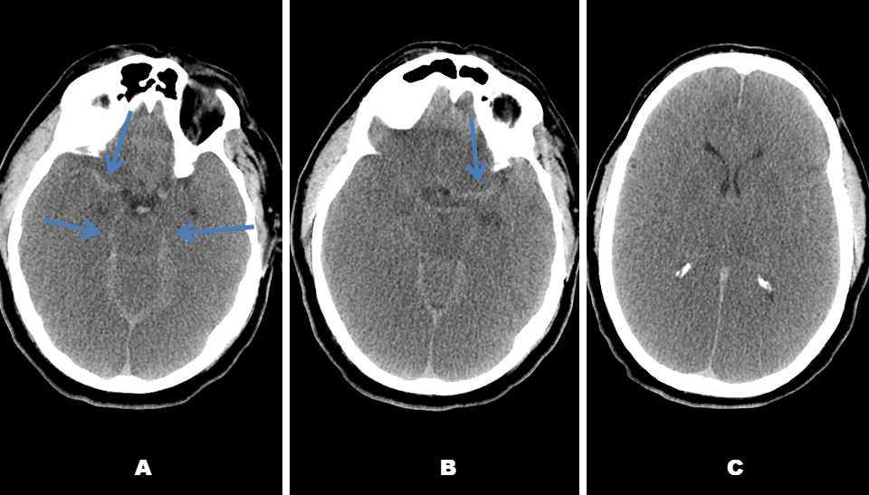 Pseudosubarachnoid Haemorrhage - a case discussion